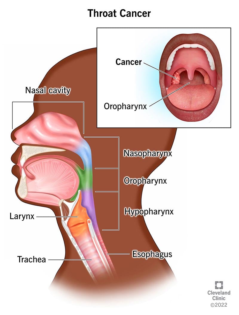 Kurgu külgvaade – ülalt alla ninaõõs, ninaneelus, orofarünks, kõri, hüpofarünks, söögitoru ja hingetoru.  Sisestatud ülemine parempoolne – (üleval vasakul) Vähikasvaja.  Orofarünksi keskus