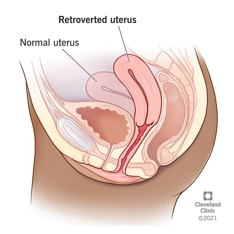 Naise reproduktiivanatoomia, mis näitab kallutatud emakat.