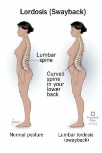 23908 lordosis