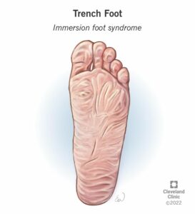 24392 trench foot