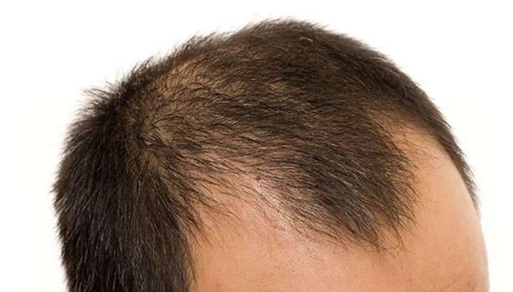 24515 male pattern baldness