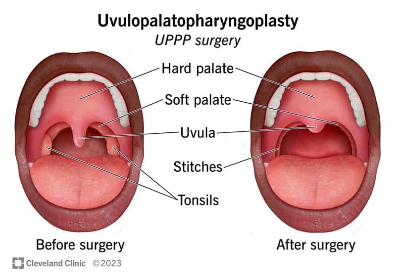 25059 uvulopalatopharyngoplasty