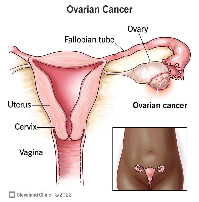 4447 ovarian cancer