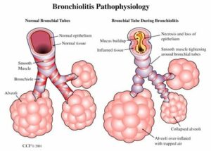 8272 pediatric bronchiolitis.ashx