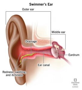 8381 swimmers ear