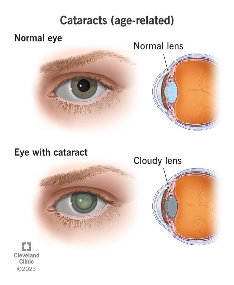 8589 cataracts