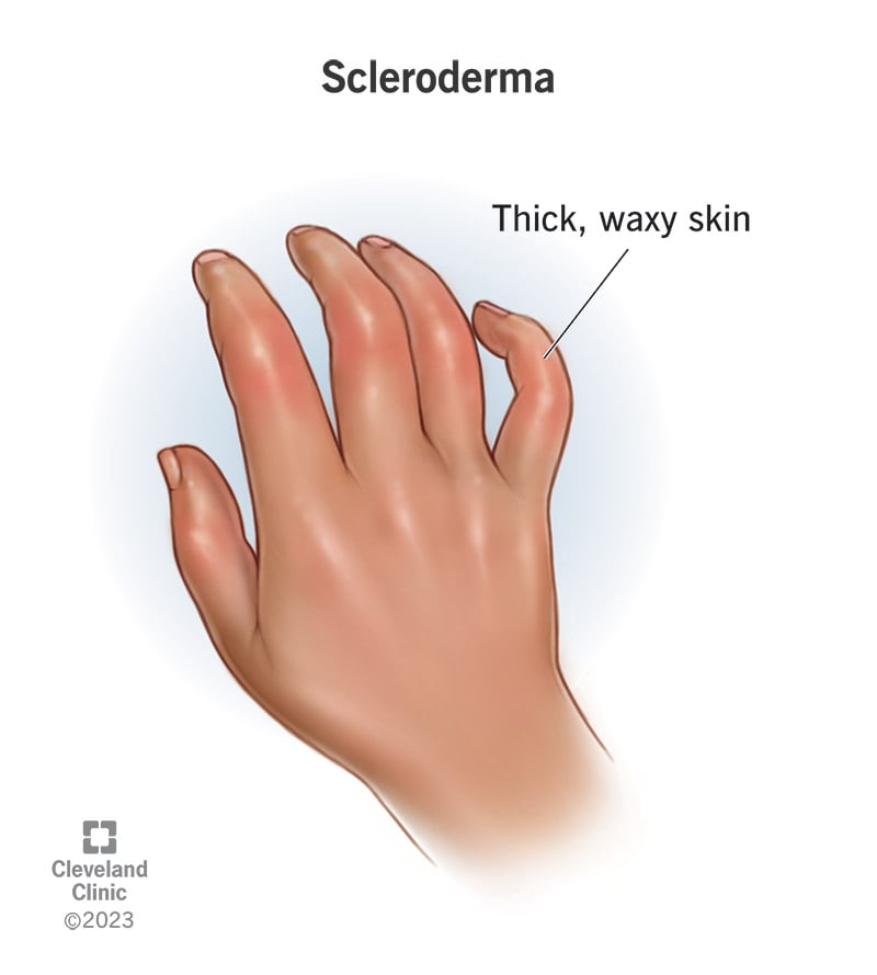8979 scleroderma