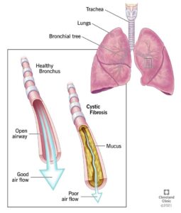 9358 cystic fibrosis