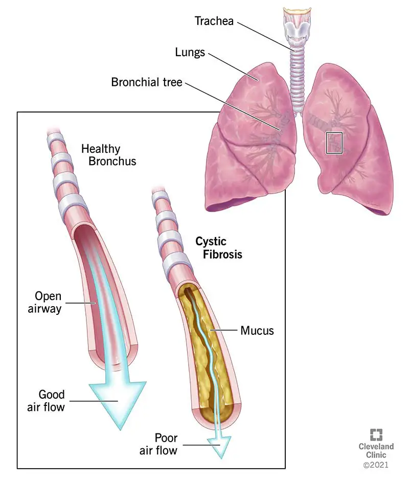 9358 cystic fibrosis