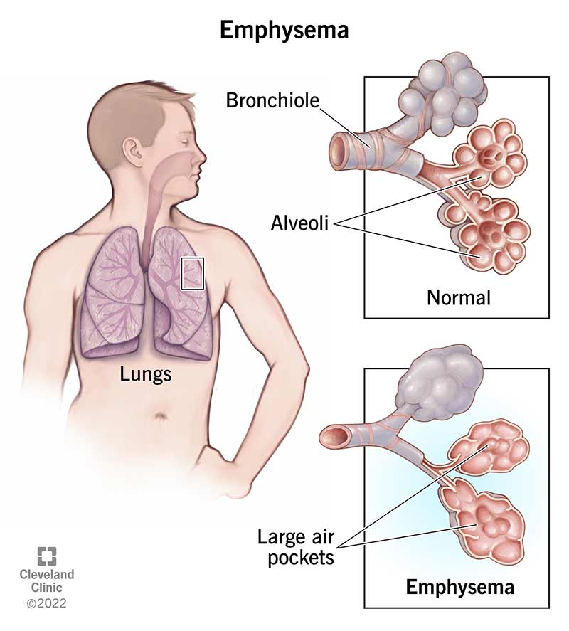 9370 emphysema