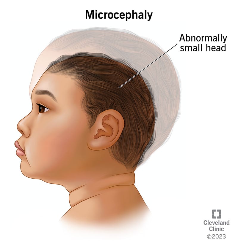 9843 microcephaly