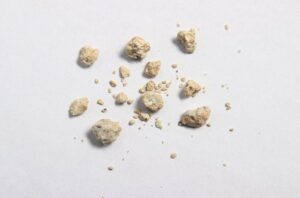 KidneyStones 952988256 770x533 1 650x428