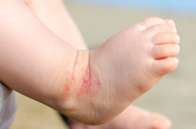 baby feet with Eczema 596089610 770x533 1