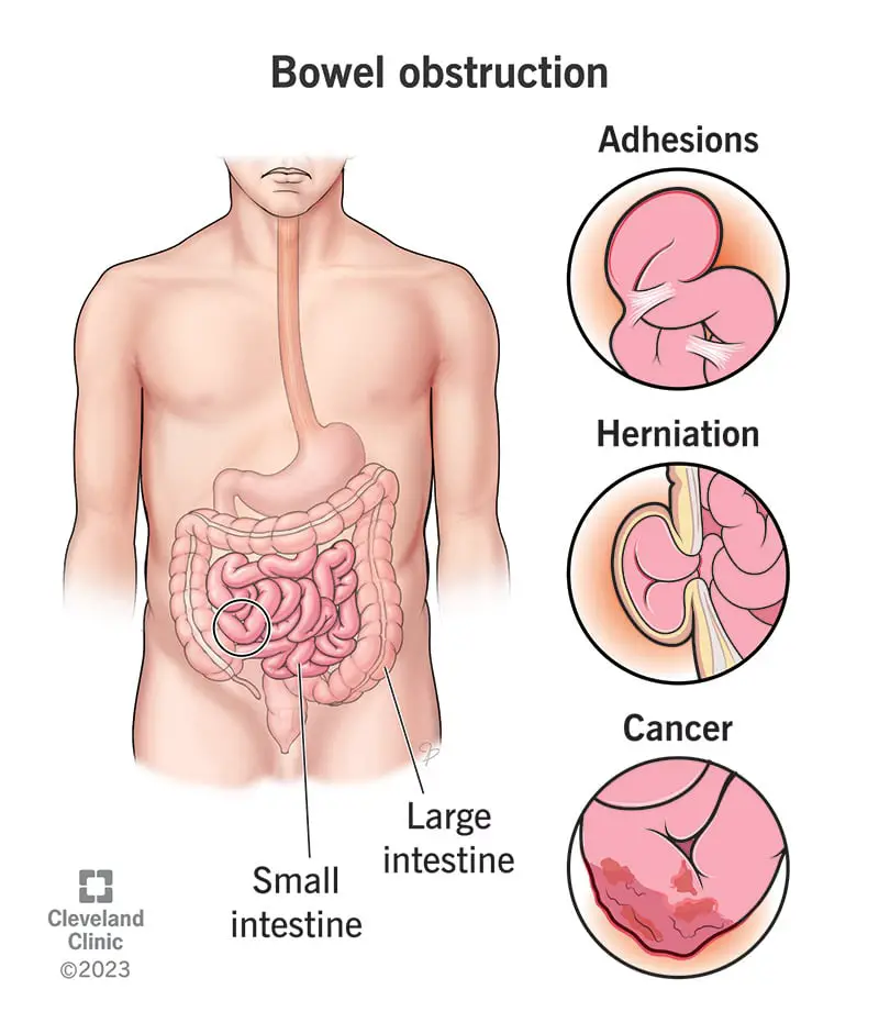 bowel obstruction