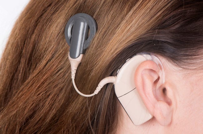 cochlearImplant 464470338 770x553