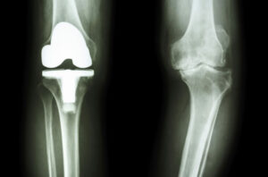 joint replacement xray iStock 000038796200 Large 650x428