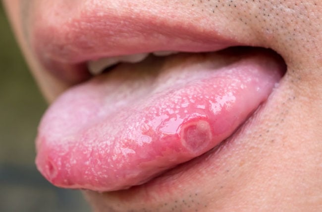 mouthUlcers 956084414 770x533 1