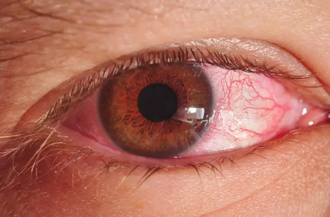 pinkEye 165755073 770x533 1