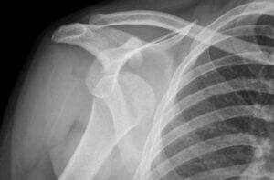 shoulderDislocatedXray 183212469 770x533 1 650x428