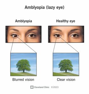 10707 amblyopia lazy eye