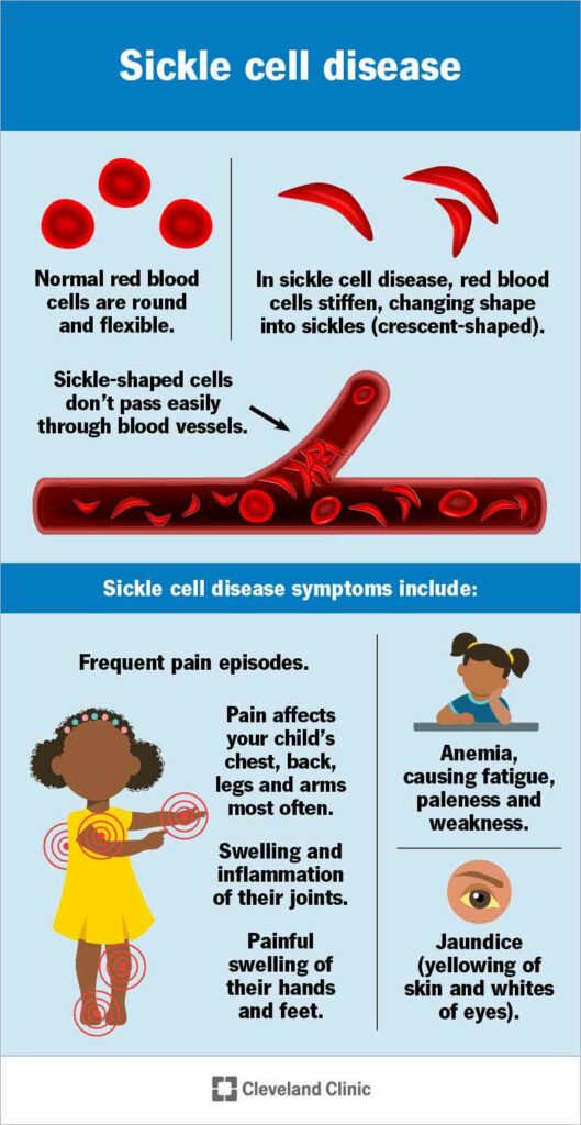 12100 sickle cell disease