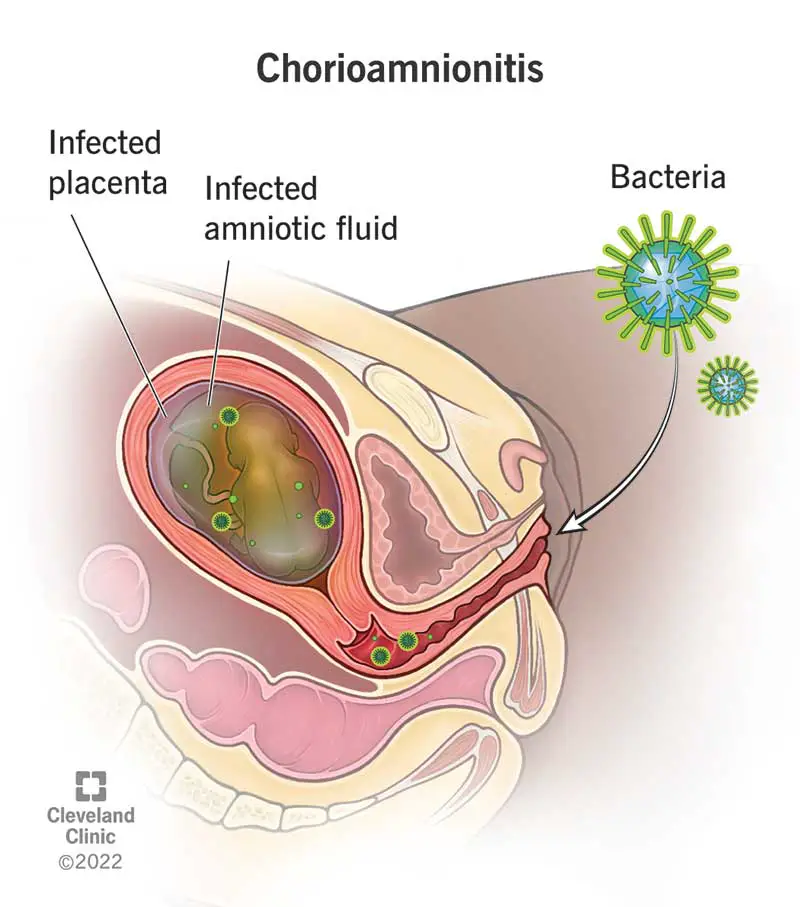 12309 chorioamnionitis