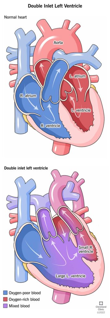 14786 double inlet left ventricle