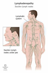 15219 swollen lymph nodes