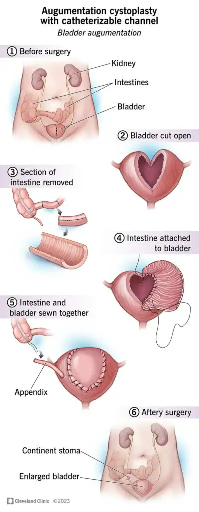 15846 cystoplasty