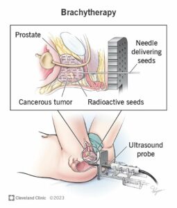 16500 brachytherapy