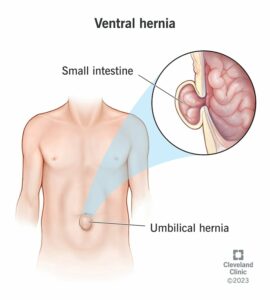 16531 ventral hernia