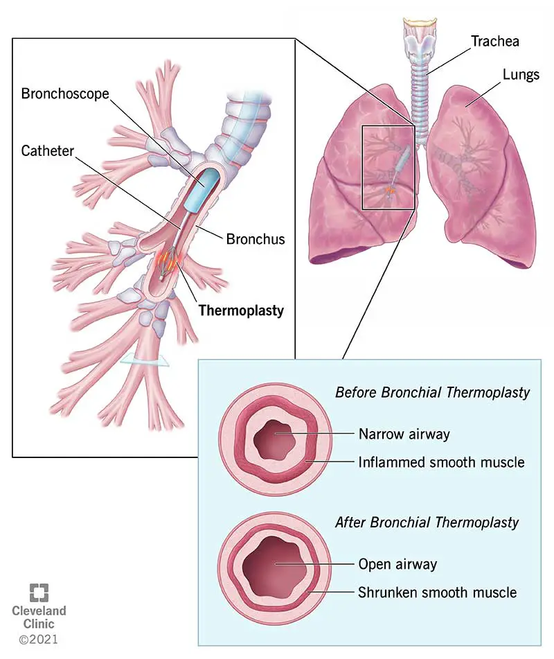 16811 bronchial thermoplasty