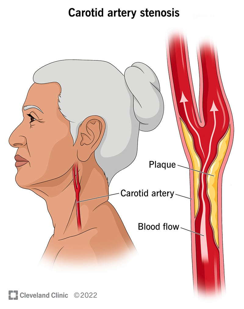 16845 carotid artery stenosis