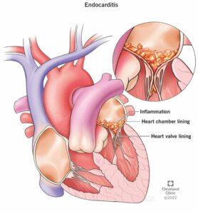 16957 endocarditis