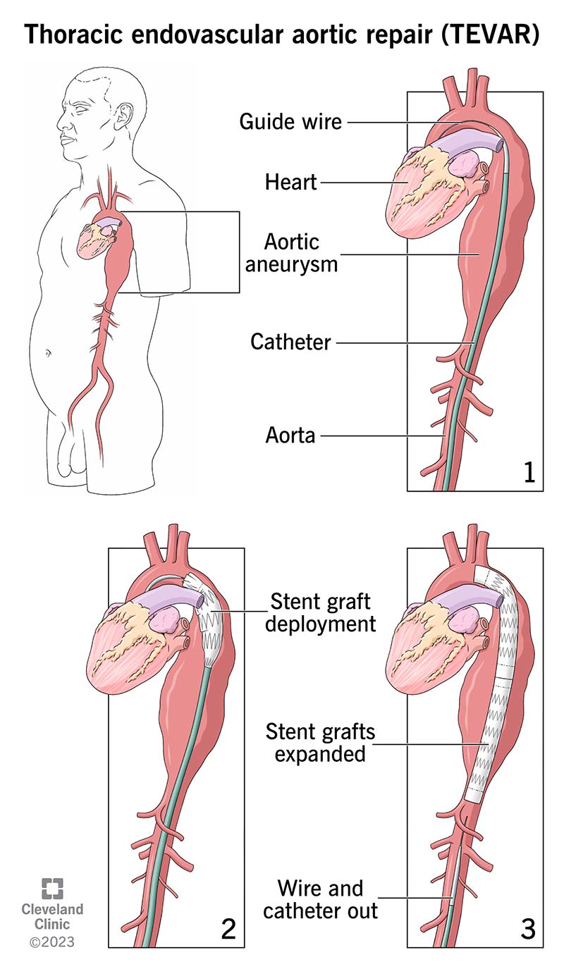 Teie teenusepakkuja kasutab kateetrit, et viia teie aordi stent ja parandada aneurüsmi.