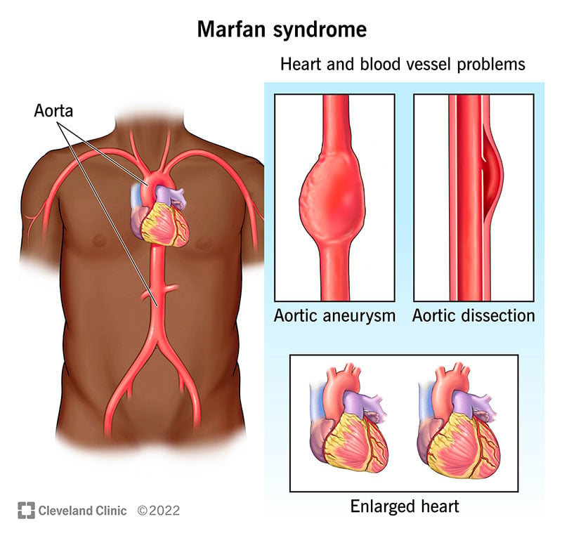 17209 marfan syndrome