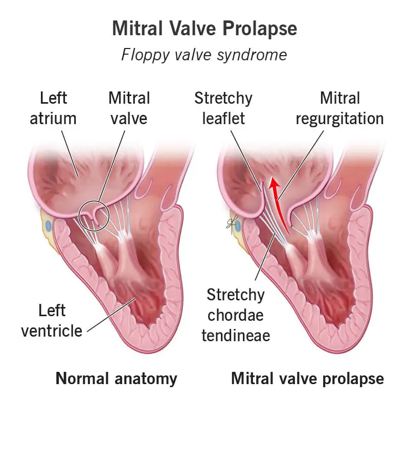 17241 mitral valve prolapse