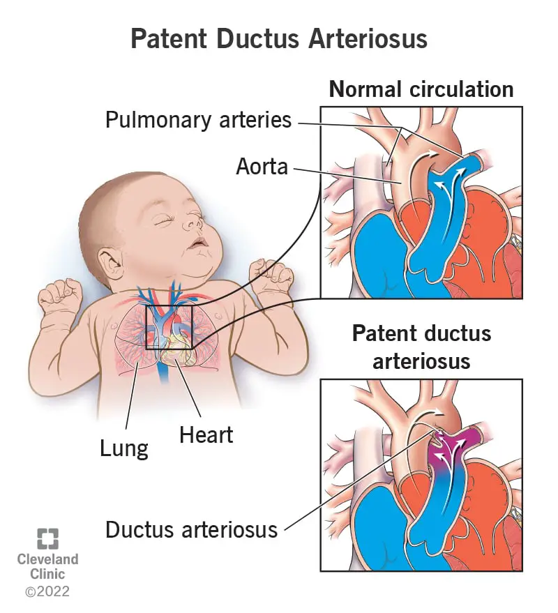 patent-ductus-arteriosus-pda-s-mptomid-ja-ravi-sfomc