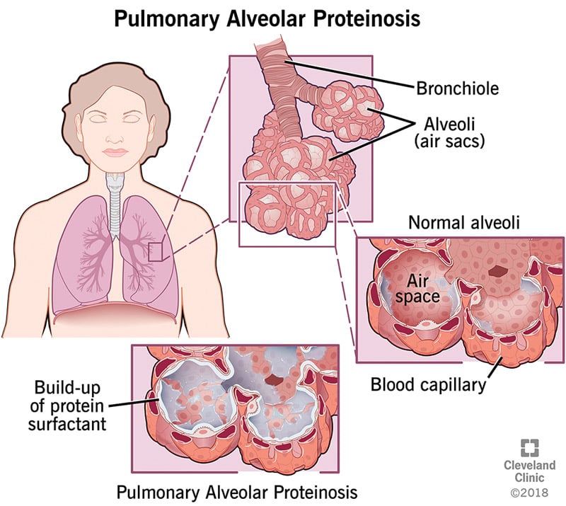 Kopsu bronhioolide normaalsed alveoolid vere kapillaaride ja valgu pindaktiivse aine kogunemine kopsualveolaarse proteinoosiga alveoolidesse