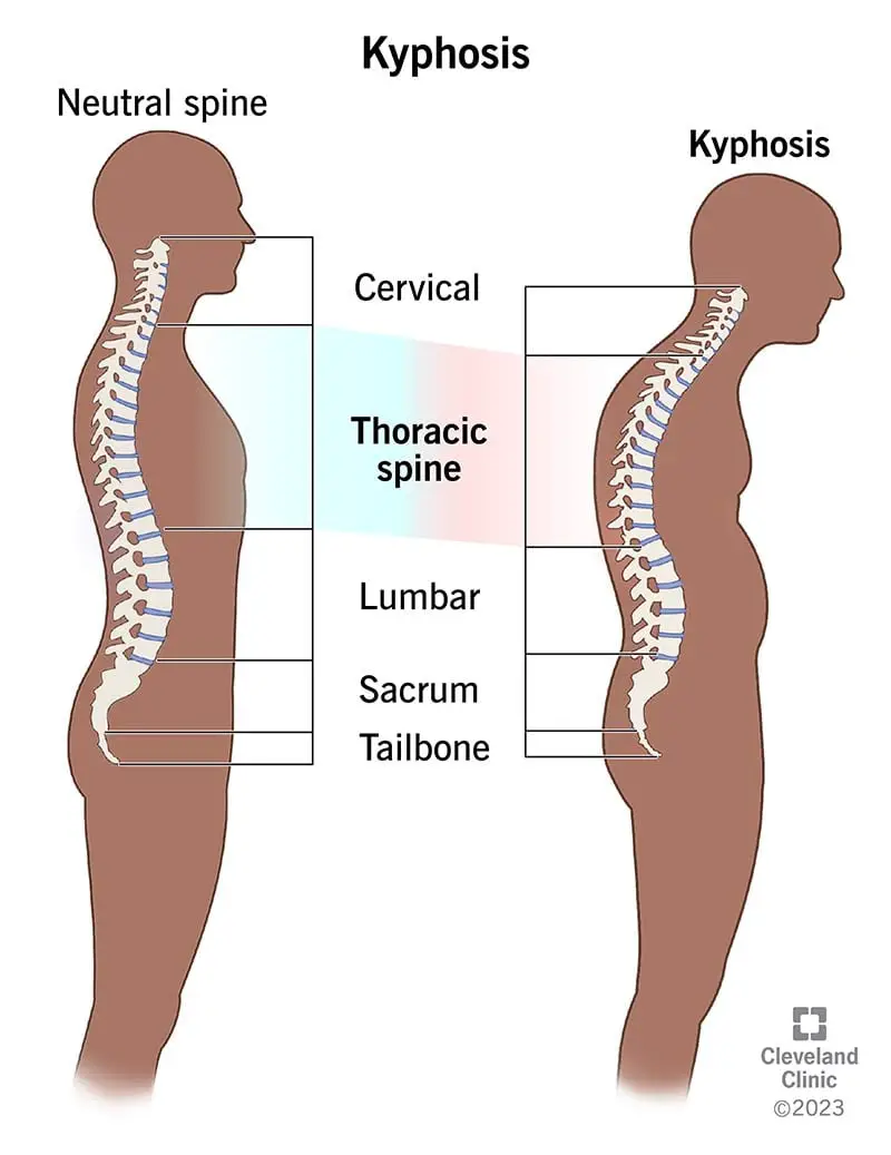 Loomulik selg ja kumer selg koos kyphosis.