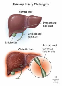 17715 primary biliary cholangitis