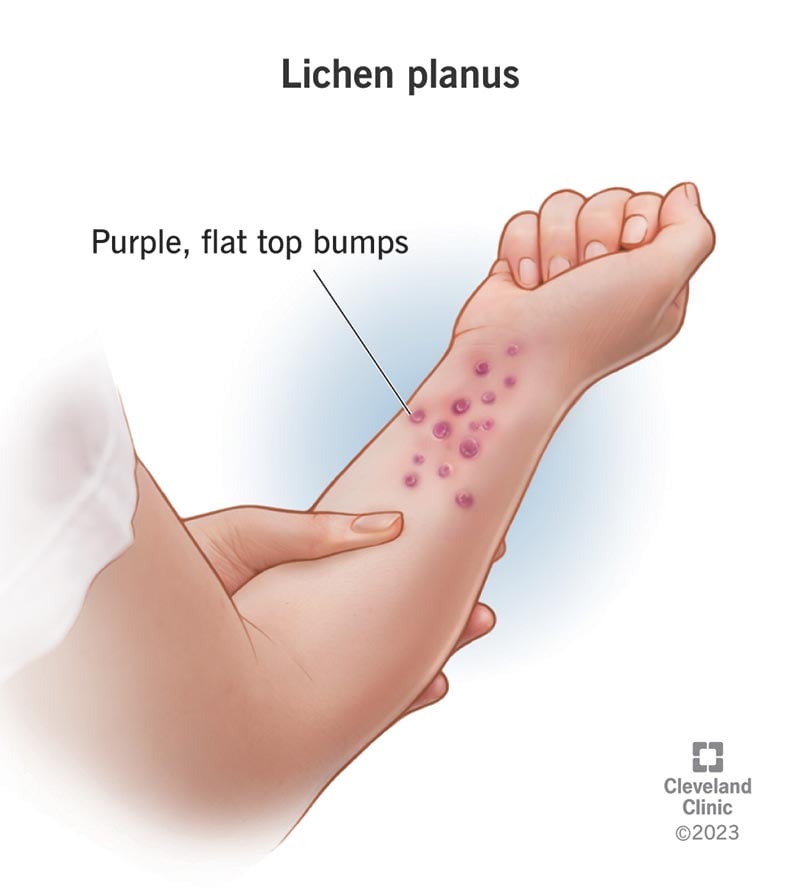 17723 lichen planus