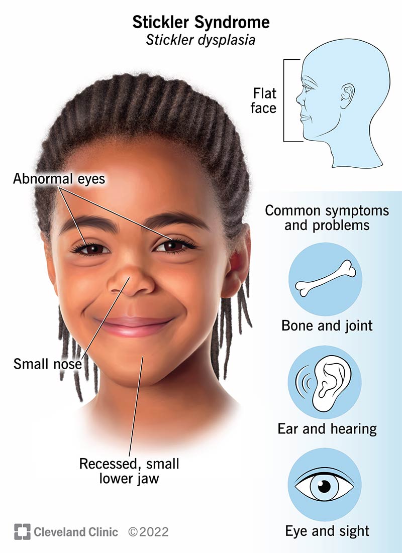 Illustratsioon sümptomitest, mis mõjutavad last, kellel on diagnoositud Stickleri sündroom.