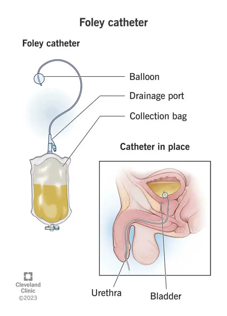 21122 foley catheter