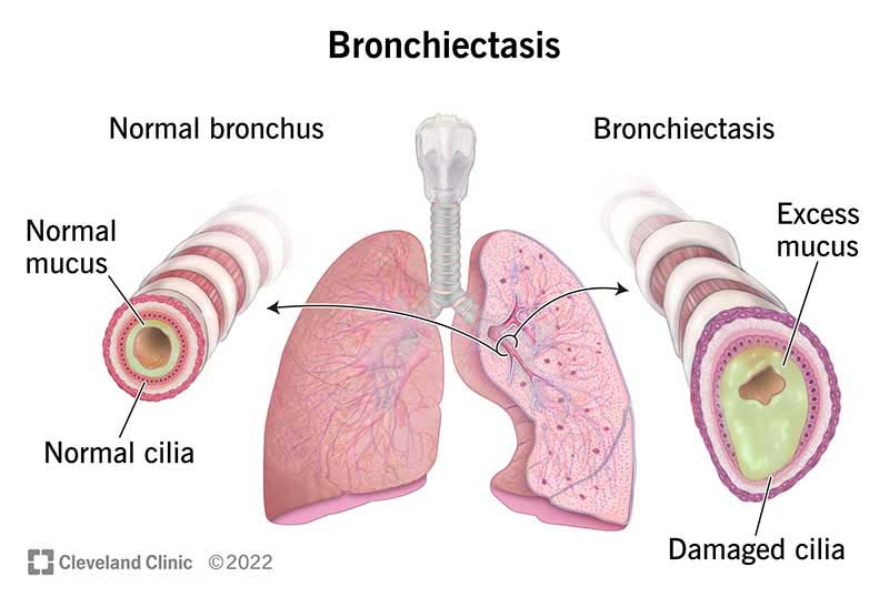 21144 bronchiectasis