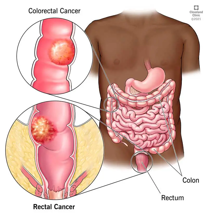 21733 rectal cancer illustration