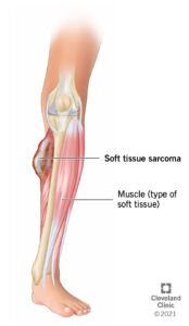 21752 Soft Tissue Sarcoma Illustration