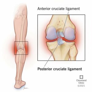 21793 posterior cruciate ligament tear