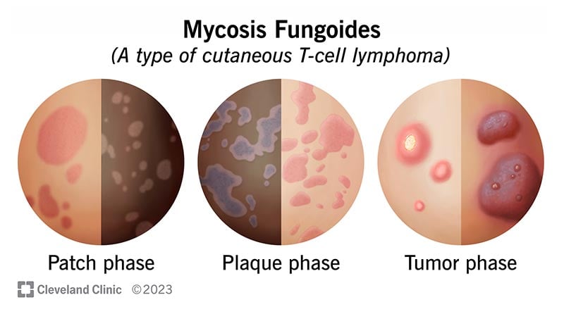 Illustratsioonid, mis näitavad Mycosis fungoides'i plaastrit, naastu ja kasvajafaase nii heledal kui ka tumedal nahal.