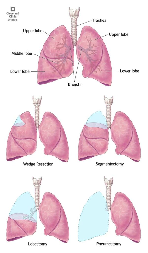 21868 lung resection